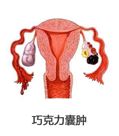 卵巢巧克力囊肿
